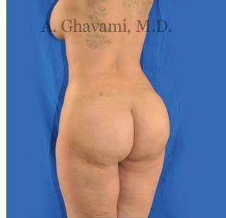 Buttock Augmentation Before & After Patient #7726