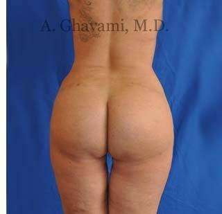 Buttock Augmentation Before & After Patient #7726