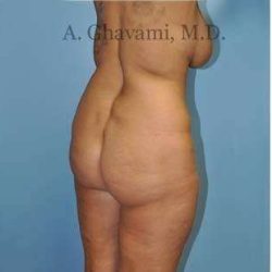 Buttock Augmentation Before & After Patient #7726