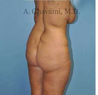 Buttock Augmentation Before & After Patient #7726