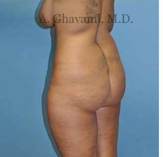 Buttock Augmentation Before & After Patient #7726