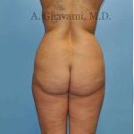 Buttock Augmentation Before & After Patient #7726