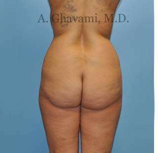 Buttock Augmentation Before & After Patient #7726
