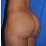 Buttock Augmentation Before & After Patient #7719
