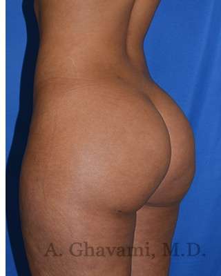 Buttock Augmentation Before & After Patient #7719