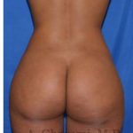 Buttock Augmentation Before & After Patient #7719
