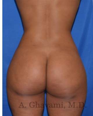 Buttock Augmentation Before & After Patient #7719