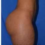 Buttock Augmentation Before & After Patient #7719