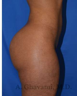 Buttock Augmentation Before & After Patient #7719