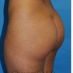 Buttock Augmentation Before & After Patient #7719