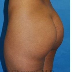 Buttock Augmentation Before & After Patient #7719