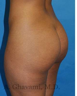 Buttock Augmentation Before & After Patient #7719