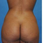 Buttock Augmentation Before & After Patient #7719