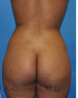 Buttock Augmentation Before & After Patient #7719