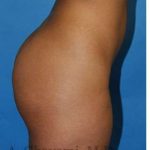 Buttock Augmentation Before & After Patient #7719