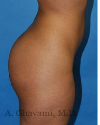 Buttock Augmentation Before & After Patient #7719