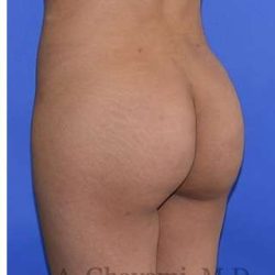 Buttock Augmentation Before & After Patient #7712