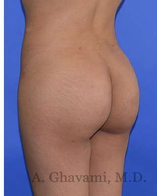 Buttock Augmentation Before & After Patient #7712