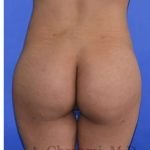 Buttock Augmentation Before & After Patient #7712