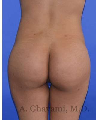 Buttock Augmentation Before & After Patient #7712