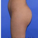 Buttock Augmentation Before & After Patient #7712