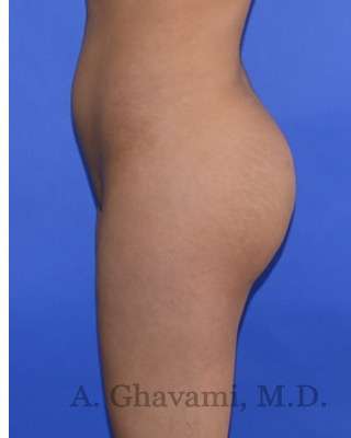 Buttock Augmentation Before & After Patient #7712