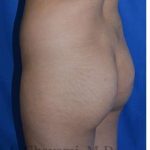 Buttock Augmentation Before & After Patient #7712