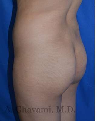 Buttock Augmentation Before & After Patient #7712