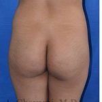 Buttock Augmentation Before & After Patient #7712