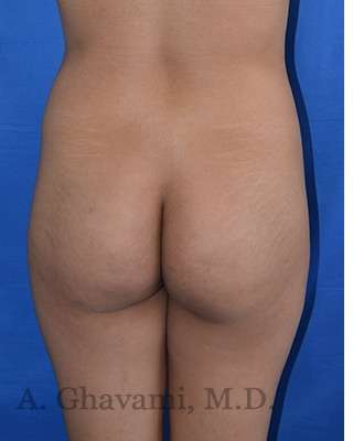 Buttock Augmentation Before & After Patient #7712