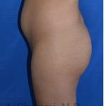 Buttock Augmentation Before & After Patient #7712