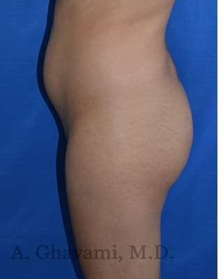 Buttock Augmentation Before & After Patient #7712