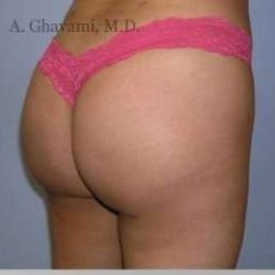 Buttock Augmentation Before & After Patient #7705