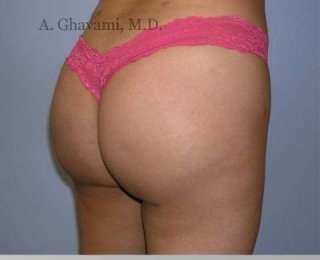 Buttock Augmentation Before & After Patient #7705