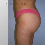 Buttock Augmentation Before & After Patient #7705