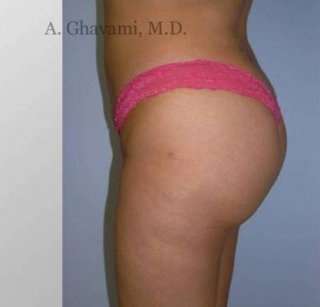 Buttock Augmentation Before & After Patient #7705