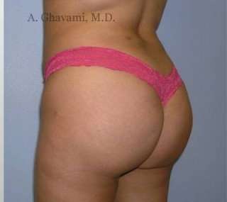 Buttock Augmentation Before & After Patient #7705