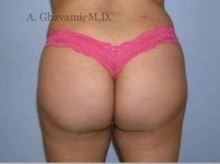 Buttock Augmentation Before & After Patient #7705