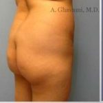 Buttock Augmentation Before & After Patient #7705