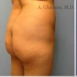 Buttock Augmentation Before & After Patient #7705