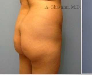 Buttock Augmentation Before & After Patient #7705