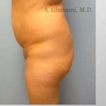 Buttock Augmentation Before & After Patient #7705