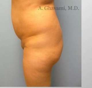 Buttock Augmentation Before & After Patient #7705