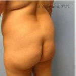 Buttock Augmentation Before & After Patient #7705