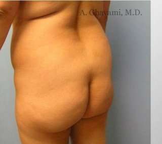 Buttock Augmentation Before & After Patient #7705