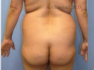 Buttock Augmentation Before & After Patient #7705