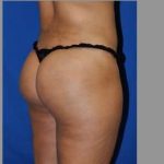 Buttock Augmentation Before & After Patient #7696
