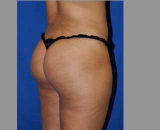Buttock Augmentation Before & After Patient #7696