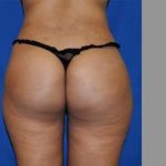 Buttock Augmentation Before & After Patient #7696