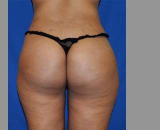 Buttock Augmentation Before & After Patient #7696